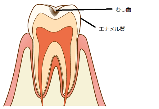②歯科助手の勉強：むし歯の種類（病名）