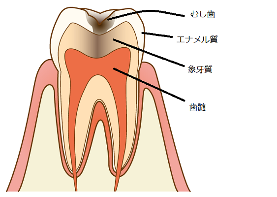 ②歯科助手の勉強：むし歯の種類（病名）