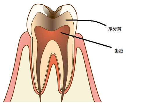 ②歯科助手の勉強：むし歯の種類（病名）