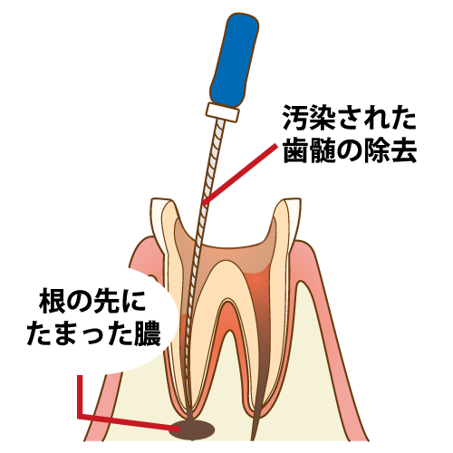 ■歯科助手の勉強：C3急化pulとC3急化perの違い