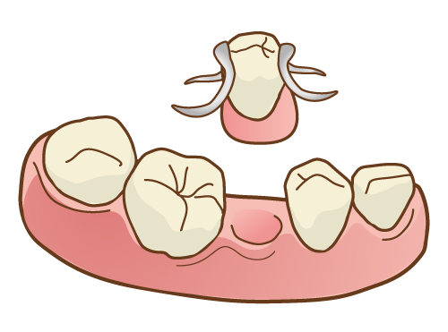 ■歯科助手の勉強：部分入れ歯（保険適用内）