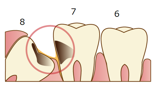 ■歯科助手の勉強：８番の親知らず－抜歯/補填なし