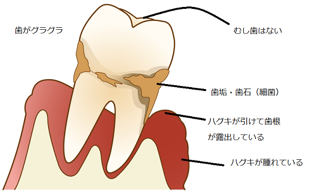 ②歯科助手の勉強：むし歯の種類（病名）