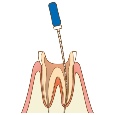 １．歯科用語【RCT】とは？【RCT】とは、根っこの治療で、ルートカナル・トリートメントの略語。